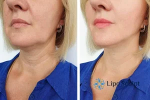 Double chin before and after Hi-Fu treatment 4 Book your double chin treatment Bedford today! We are here to help!