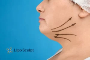 Double chin before and after Hi-Fu treatment 3 Boost your confidence with a Double chin treatment Bedford