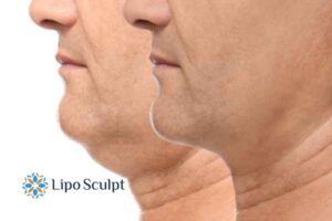 Double chin before and after Hi-Fu treatment 2 Double chin treatment Bedford from Lipo Sculpt - feel more confident today!