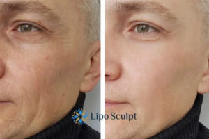 How to Fight Aging Symptoms 3 Fight Aging Symptoms Bedford With HIFU and Morpheus8 Today!