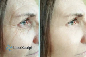 How to Fight Aging Symptoms 2 Do you want to Fight Aging Symptoms Bedford? Contact Lipo Sculpt today!