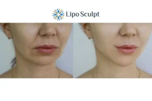 Explaining Total Skin Tightening Treatment And What It Can Do For You 2 Do you want to boost your self confidence? Give Morpheus8 Bedford a try today!