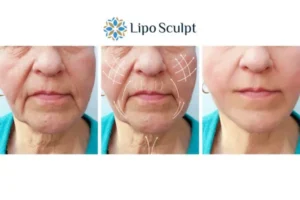 Explaining Total Skin Tightening Treatment And What It Can Do For You 3 Boost your confidence with Morpheus8 Bedford call our team today!