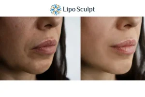 Explaining Total Skin Tightening Treatment And What It Can Do For You 4 Morpheus8 Bedford the best results - call our team today!