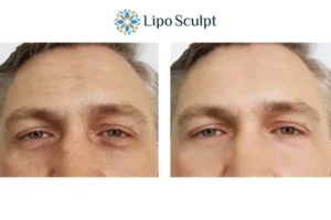 Explaining Total Skin Tightening Treatment And What It Can Do For You 6 Morpheus8 Bedford book in today to find out more!
