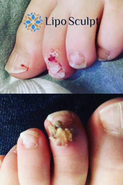 Wart removal customer results from Lipo Sculpt Bedford