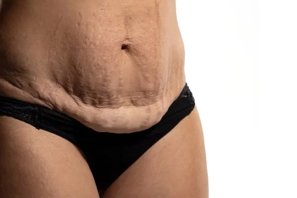 Lost the Weight but Not the Loose Skin? 1 image of womans stomach after weight loss showing loose skin Bedford